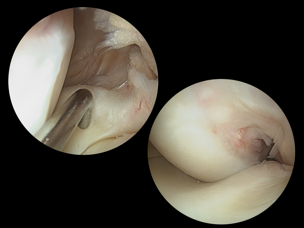 Figure 4 for case stress fracture ( RID4695 ) Osteonecrosis Meniscal Root tear